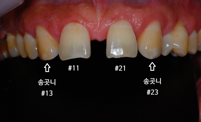 치료 전